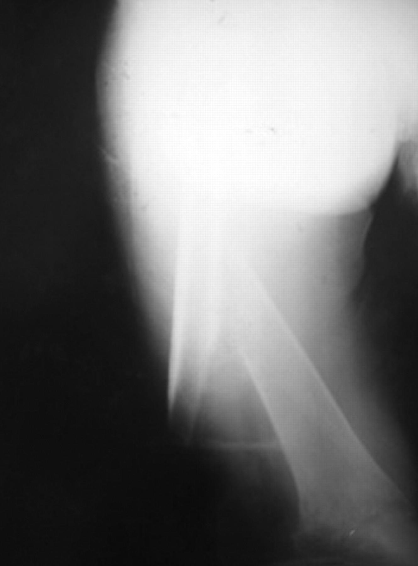 Fig. 2 
            A poor quality radiograph demonstrating a nine-month-old femoral nonunion.
          