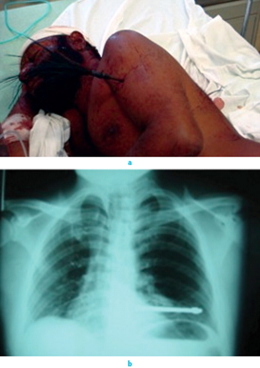 Fig. 4 
            Clinical photograph (a) and radiograph (b) of a penetrating arrow injury from village in-fighting (note arrows front and back).
          