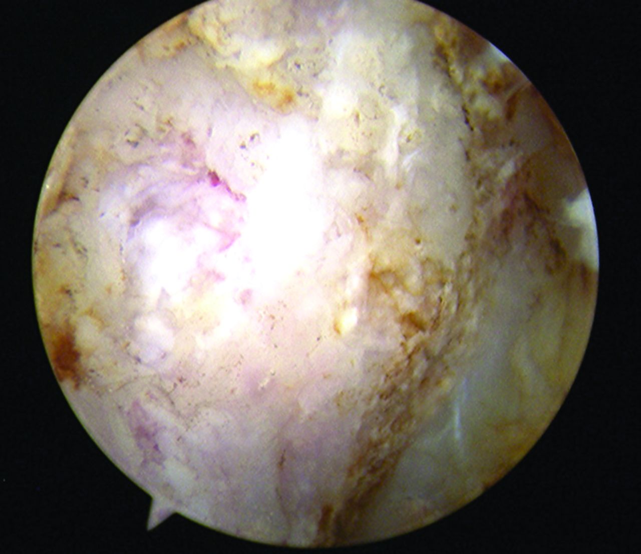 Fig. 1 
        Arthroscopic view of the medial end of right degenerated clavicle.
      