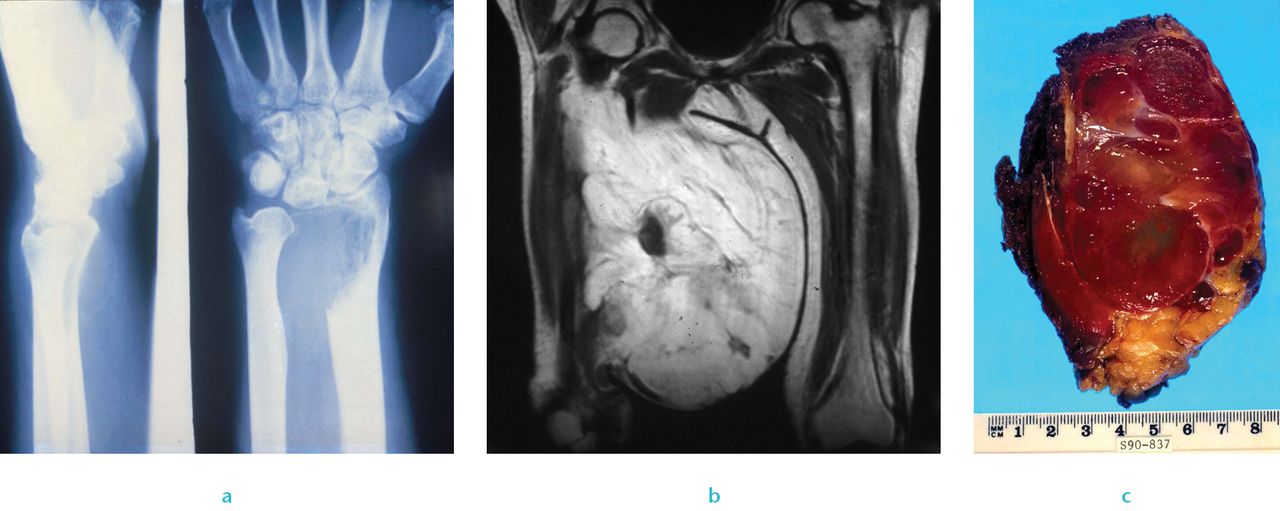 Fig. 2 
          Clinical sarcoma: a) Radiograph of a giant cell tumour of bone, b) imaging of myxoid liposarcoma and c) image of liposarcoma.
        