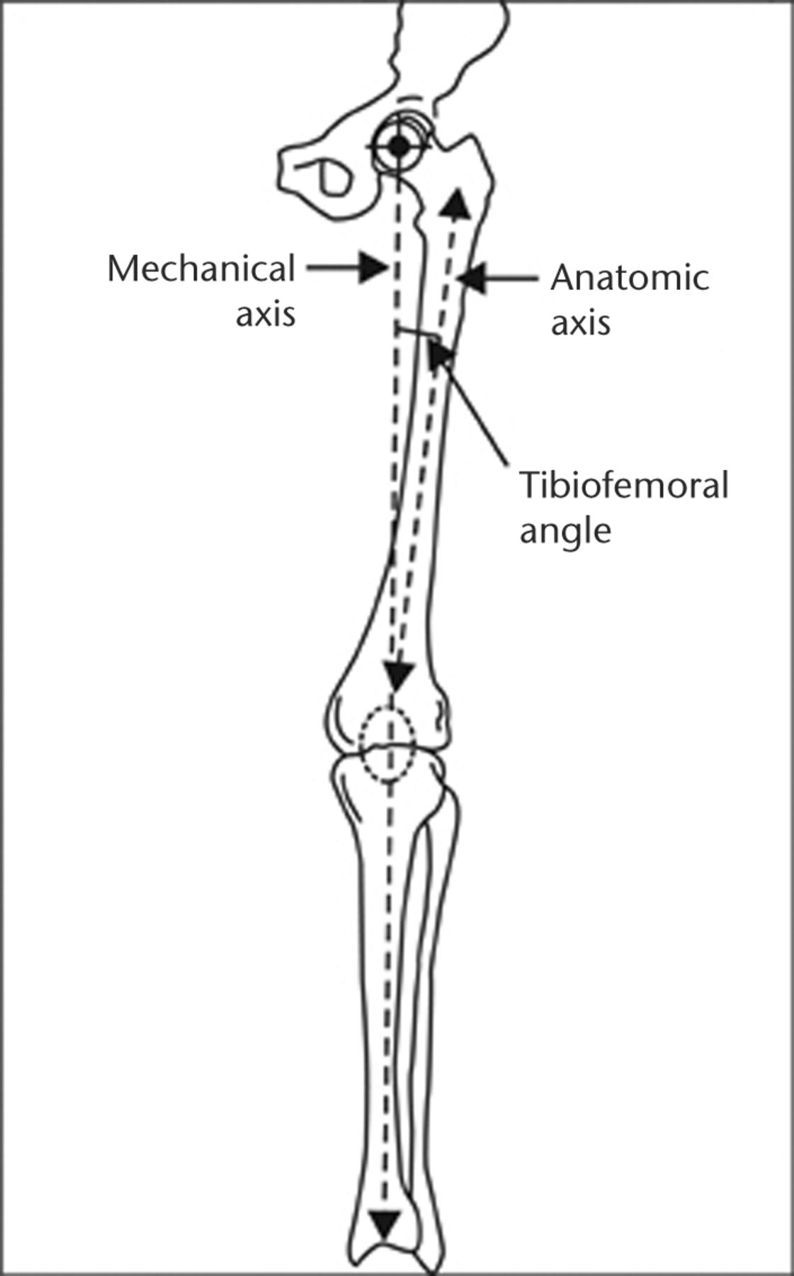 Fig. 2 
          The relationship between the mechanical and anatomic axis demonstrating the tibiofemoral angle.
        