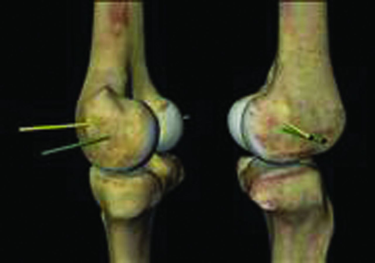 Fig. 7 
          A cylinder is superimposed onto the femoral condyle to define a single flexion and extension axis. Reprinted with permission from The Journal of Bone and Joint Surgery Inc.45
        