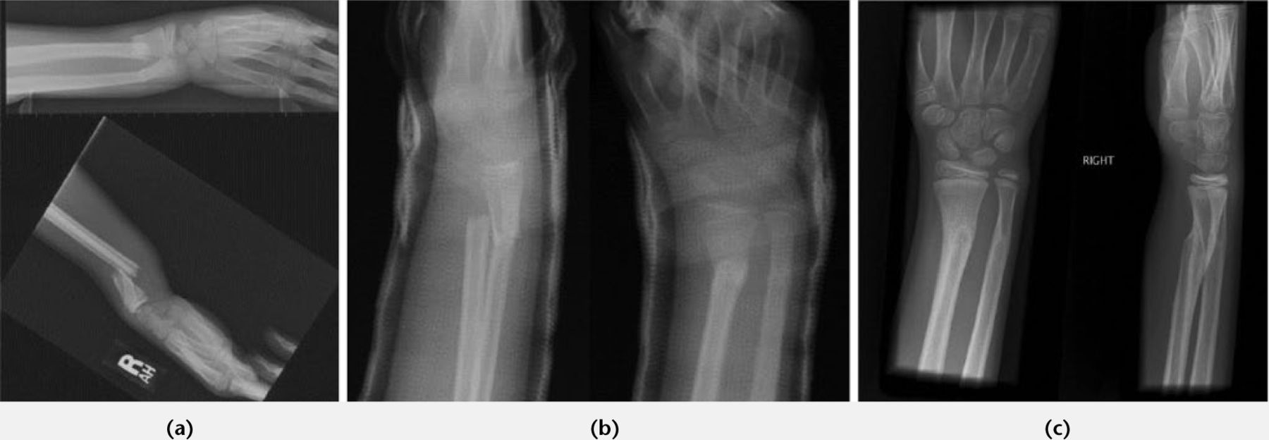 Fig. 2 
          Remodeling following conservative management of overriding distal radial fracture. a) Initial films; b) At 1 week; c) At 4 months.
        