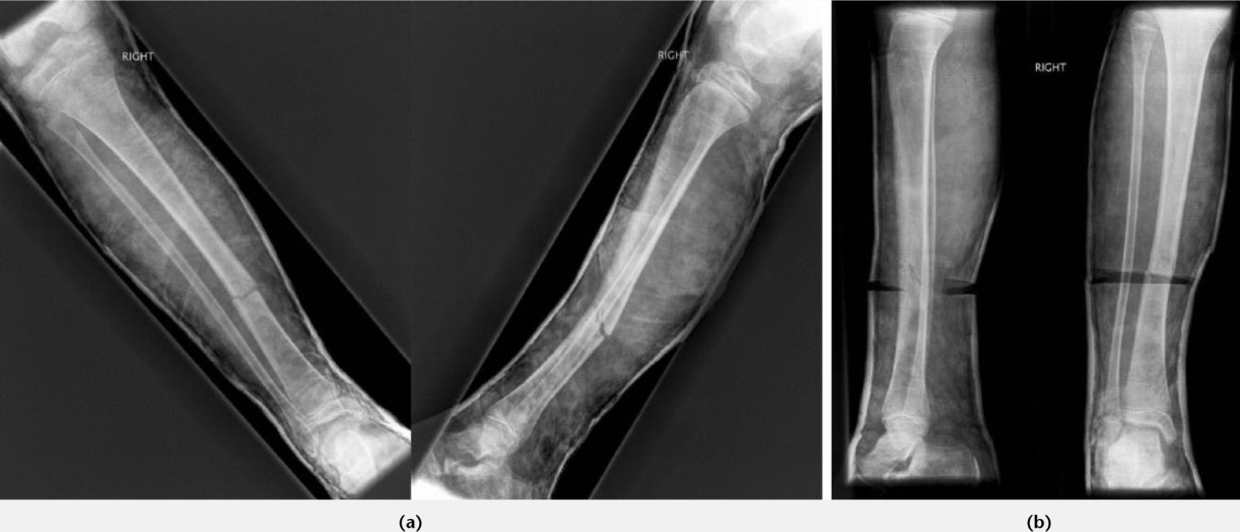 Fig. 4 
          a) Tibial fracture in cast with valgus and recurvatum deformity (apex posteromedial); b) Position corrected after wedging.
        
