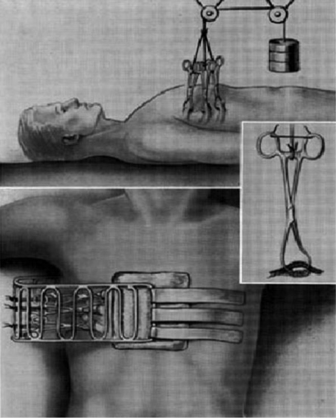 Fig. 1 
          Rudimentary chest wall traction.19
          Reproduced from the U.S. Army Medical Department Office of Medical History (http://history.amedd.army.mil/booksdocs/wwii/thoracicsurgeryvolII/chapter1figure4b.jpg). Commercial publication incorporates United States Government works (17 USC 403).
        