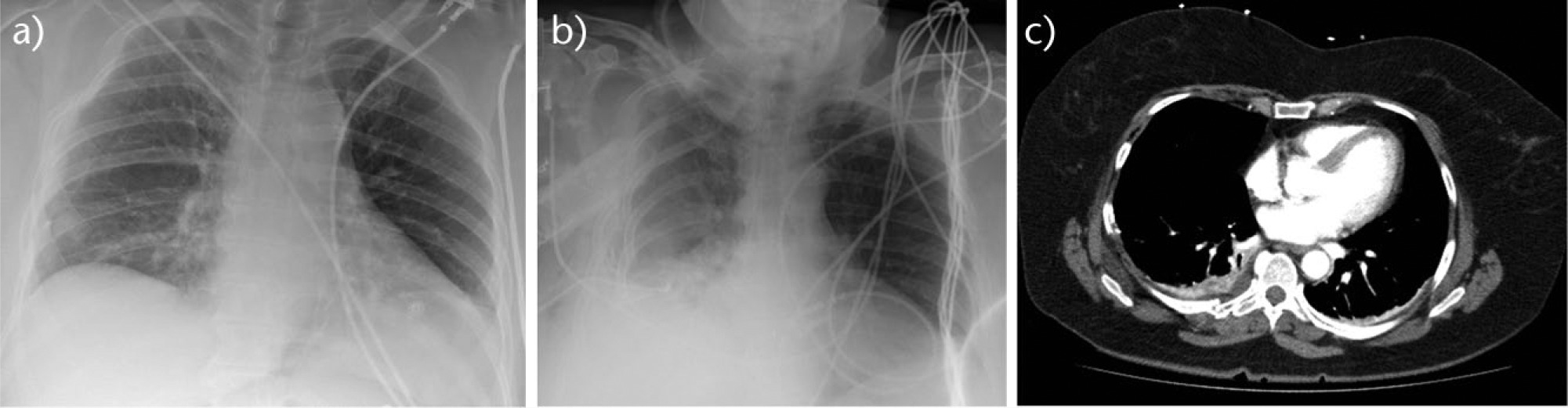 Fig. 3 
            a) Initial radiograph showing right-sided flail chest on admission; b) Radiograph taken two days later showing secondary collapse and loss of volume; c) Cross-sectional CT scan on admission demonstrating posterior fractures and a flail chest.
          