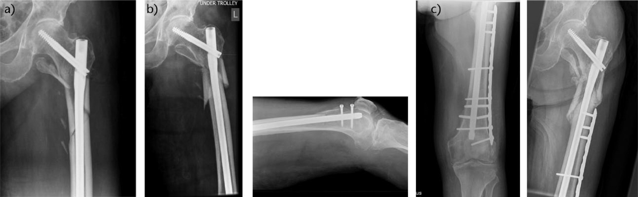 Fig. 1 
            Radiographs showing a) post-operative extended subtorchanteric fracture with acceptable reduction; b) second fall and periprosthetic fracture and c) composite revision to nail:plate construct with the nail interlocked through the plate. Despite subsequent falls, the patient heals his fracture prior to metalwork failure. Seen here united at 6 months.
          