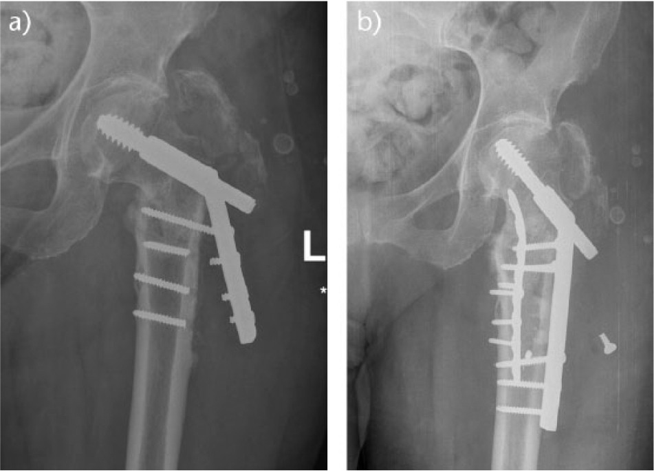 Fig. 2 
            Radiographs showing loss of femoral offset: a) failed dynamic hip screw with loss of the medial buttress and over dynamisation and b) Endosteal plating as described originally by Geoff Mast. The calcar is restored and the fracture heals.
          