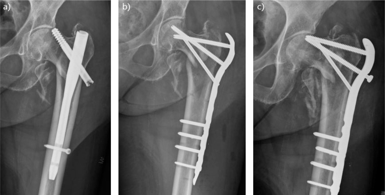 Fig. 3 
            Radiographs showing Cut out of femoral fixation: a) cassic posterosuperior screw cut-out; b) revision fixation with fixed angle device. No compression of the fracture site is possible with proximal femoral plate systems and c) Secondary failure of fixed angle proximal femoral plate system.
          