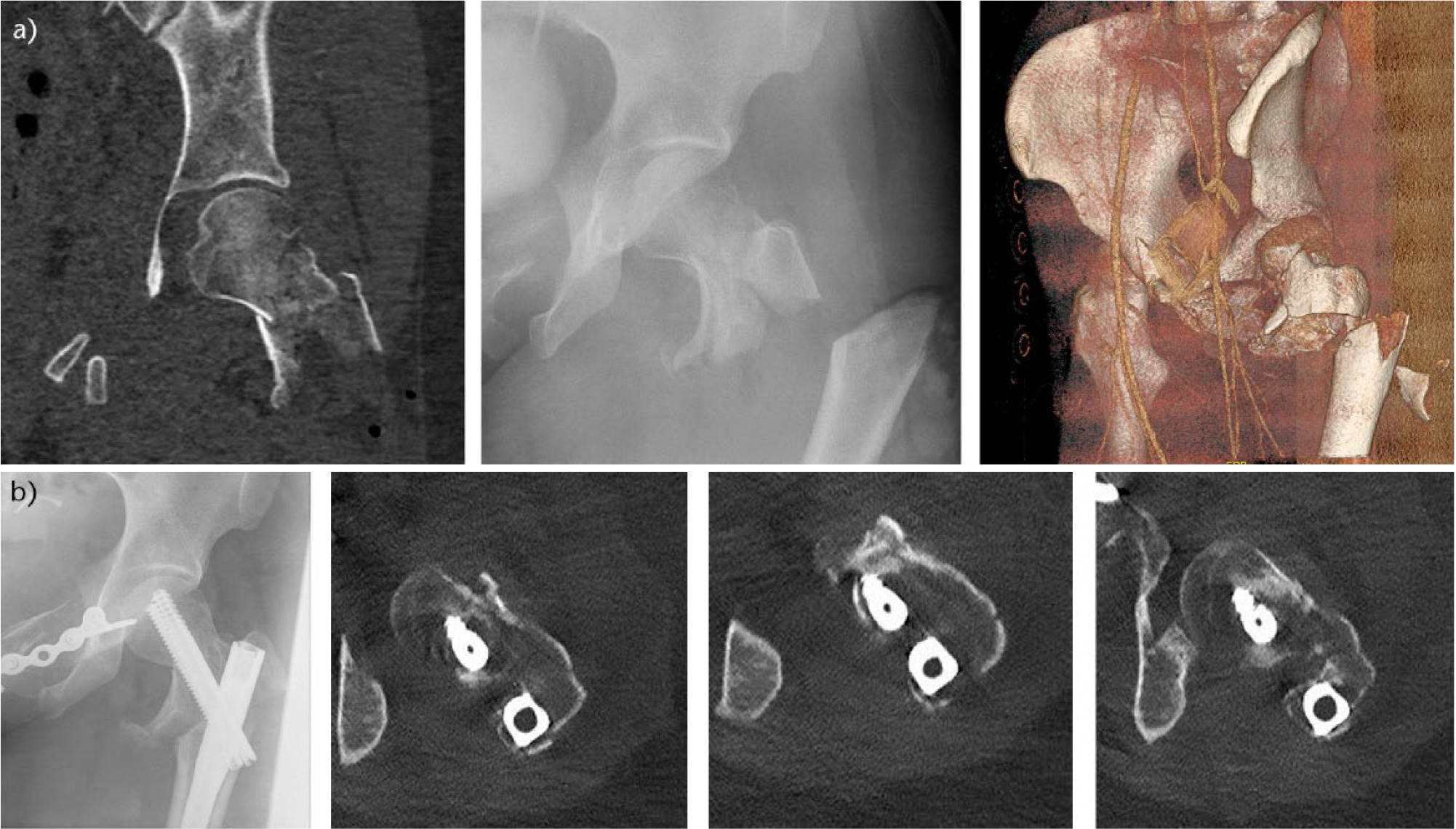 Fig. 5 
            Images showing fixed compression in a young patient; a) segmental open high energy femoral fracture with wedge component in the neck and b) 12-week radiographs and CT slices demonstrating anatomical reduction of the neck and maintenance of reduction with the fixed compression.
          