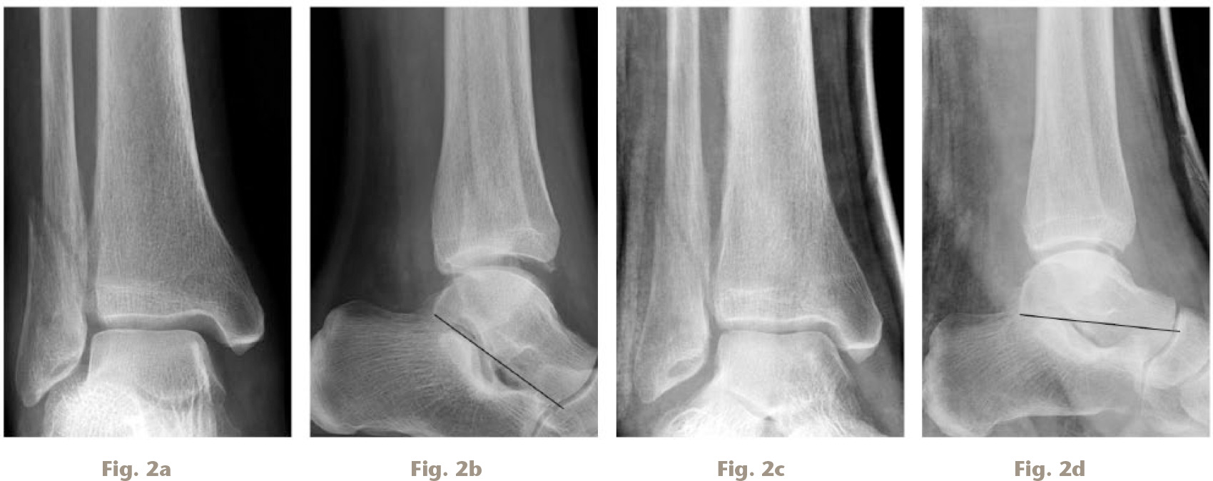 Fig. 2 
          a) Anteroposterior ankle radiograph demonstrating apparent talar shift with increased medial clear space. b) Lateral ankle radiograph of the same patient, demonstrating plantar flexion of the talus, with the smaller posterior aspect of the talus articulating with the mortise. c) Anteroposterior radiograph of the same patient with the ankle now in d) a plantargrade (neutral) position with elimination of the initial apparent talar shift.
        
