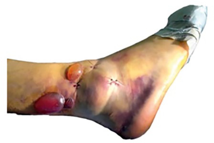 Fig. 3 
          The fibular nail is inserted and secured through three small percutaneous incisions, leaving the swollen and blistered ‘high-risk’ skin undisturbed.
        
