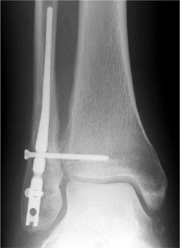 Fig. 4 
          Anteroposterior radiograph taken six weeks following surgery for treatment of an isolated lateral malleolus fracture.
        