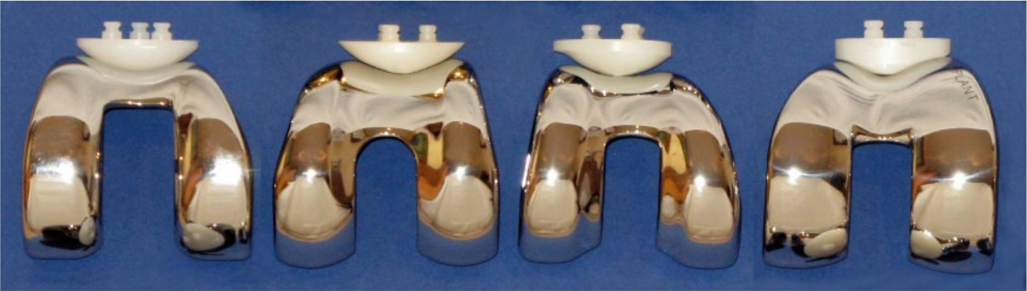 Fig. 2 
          Different patella buttons and femoral trochlea component designs. From left to right: Anatomical Graduated Component, (AGC; Zimmer Biomet, Warsaw, Indiana); PFC (Zimmer Biomet); Triathlon (Stryker, Kalamazoo, Michigan); Low Contact Stress (LCS; DePuy Synthes, Warsaw, Indiana). Figure reproduced with the kind permission of Mr Oliver Schindler, FRCS(Orth), Bristol Hip & Knee Clinic, Chesterfield Hospital, Bristol, United Kingdom. Schindler OS. The controversy of patellar resurfacing: Ibisne in medio tutissimus? Knee Surg Sports Traumatol Arthrosc 2012;20:1227-1244.
        
