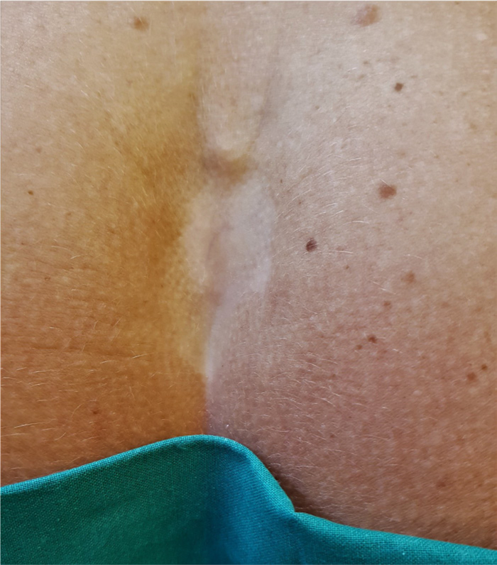 Fig. 2 
          Skin atrophy after corticosteroid injection of a patient not included in the present series.
        