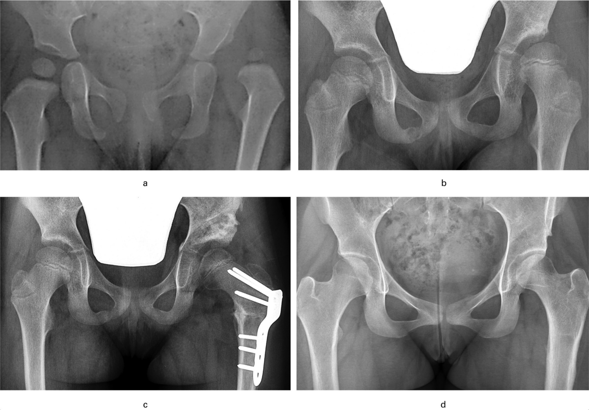 Figure 2 
          a) Primary radiograph of a girl with dislocation of her left hip, with acetabular index 23° of the right hip and 40° of the left. Closed reduction was performed at an age of 19 months. b) Radiograph at an age of six years, showing residual dysplasia with subluxation of the left hip (CE angle 9°). Dega type pelvic osteotomy and femoral varus osteotomy with shortening were performed. c) Radiograph six weeks postoperatively showing good correction of the left hip. d) Radiograph at the last follow-up at an age of 17 years, showing adequate femoral head coverage (CE angle of left hip 21°).
        