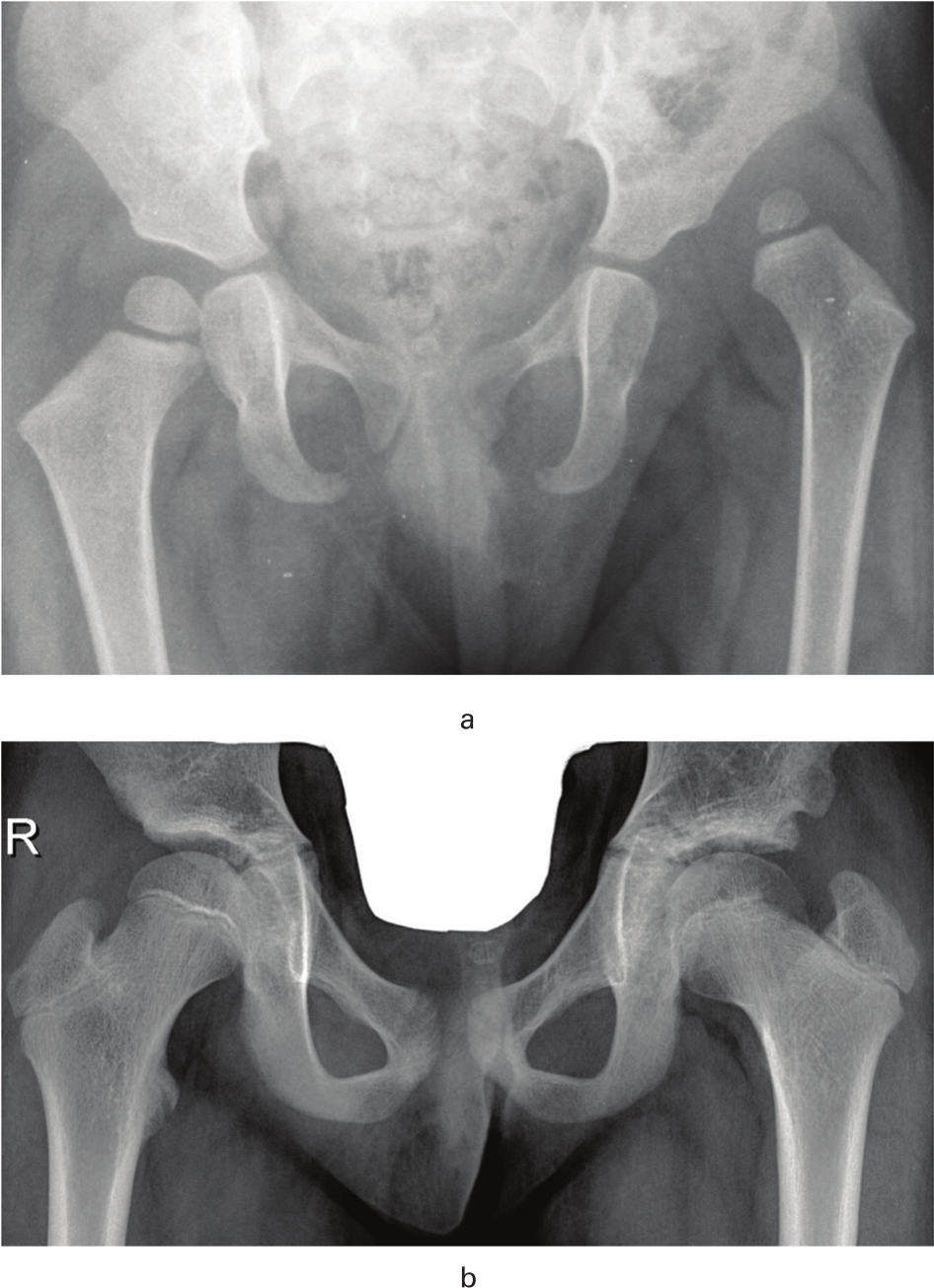 Figure 4 
          a) Primary radiograph of a girl with dislocation of her left hip, with acetabular index 23° of the right hip and 33° of the left. Redislocation occurred after closed reduction, and open reduction was performed at an age of 21 months. b) Radiograph at patient age ten years, showing marked improvement of the acetabulum (acetabular index 8°) and good femoral head coverage.
        