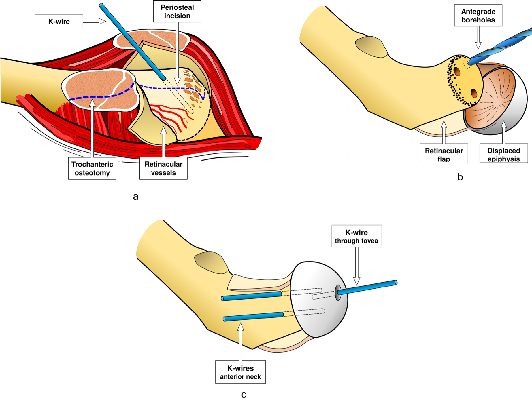 Fig. 1 
            a) Shows the surgical site after Z-shaped capsulotomy and trochanteric slide osteotomy of a left hip. The obliquely running apophyseal growth plate of the greater trochanter is visible. The slip zone with partially torn periosteal sheet at the head-neck junction and the femoral head in its posterior slip position are drawn. The blue dotted lines indicate the reduction osteotomy of the posterior and superior aspects of the neck and the L-shaped (superior towards anterior) incision of the periosteum for safe development of the extended periosteal flap leaving intact the terminal subsynovial branches of the deep branch of the medial femoral circumflex artery. The head is securely fixed with a K-wire. b) After removal of all the cartilage of the growth plate two distal and one proximal antegrade boreholes for later definitive stabilization of the epiphysis are made. This technical modification allows optimal positioning of the definitive implants at the level of head-neck junction. c) After manual reduction of the femoral head, a first provisional K-wire is introduced antegrade through the fovea of the head and the head offset is controlled visually and manually all around the neck. Then two retrograde K-wires are introduced from the anterior aspect of the neck, the first K-wire removed, the hip relocated and hip clearance checked. Correct bleeding out of a borehole of the head is assessed after reduction and provisional fixation.
          