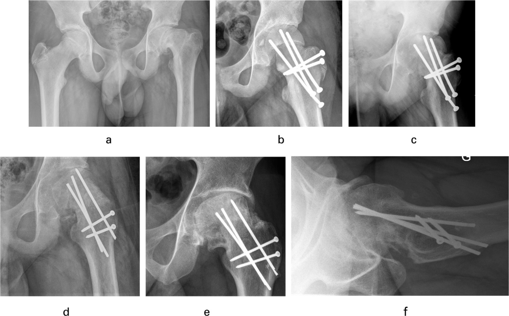 Fig. 2 
          a) 13.7 years old patient presenting with a 1.5-year history of left knee pain showing a severe chronic slip. b) Postoperative radiograph showing overcorrection with severe valgus position of the epiphysis and concomitant lateralization of the head. The head shows radiotransparency as sign of pre-existing AVN in its superior segment. c) Shows AVN with lateral femoral head subluxation at 12 weeks. d) Anteroposterior radiograph after the second hip dislocation with varisation of the epiphysis to re-center the hip and rotate the necrotic parts of the femoral head out of the weight-bearing area. e) Situation at 9.5 years. f) The femoral head is re-centered in both planes and the necrotic parts of the head at least partially remodeled. The subjective outcome is good (mHHS 95, HOOS 97.5, MdA 16, UCLA 10).
        