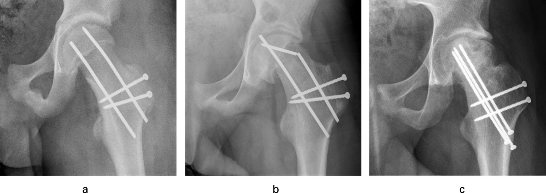 Fig. 3 
          a) Shows the postoperative result in a 13.3-year-old patient who presented with a mild SCFE. Stabilization was performed using only two threaded K-wires. b) At 12 weeks, secondary dislocation, implant fatigue failure and intra-articular protrusion of one K-wire occurred, needing revision surgery. c) Radiographic result at six years showing partial AVN and flattening of the lateral head segment. In addition, the adjacent acetabulum is sclerotic and flattened due to the remodeling process. Nevertheless, the outcome is good (mHHS 94, HOOS 97.5, MdA 16, UCLA 9).
        