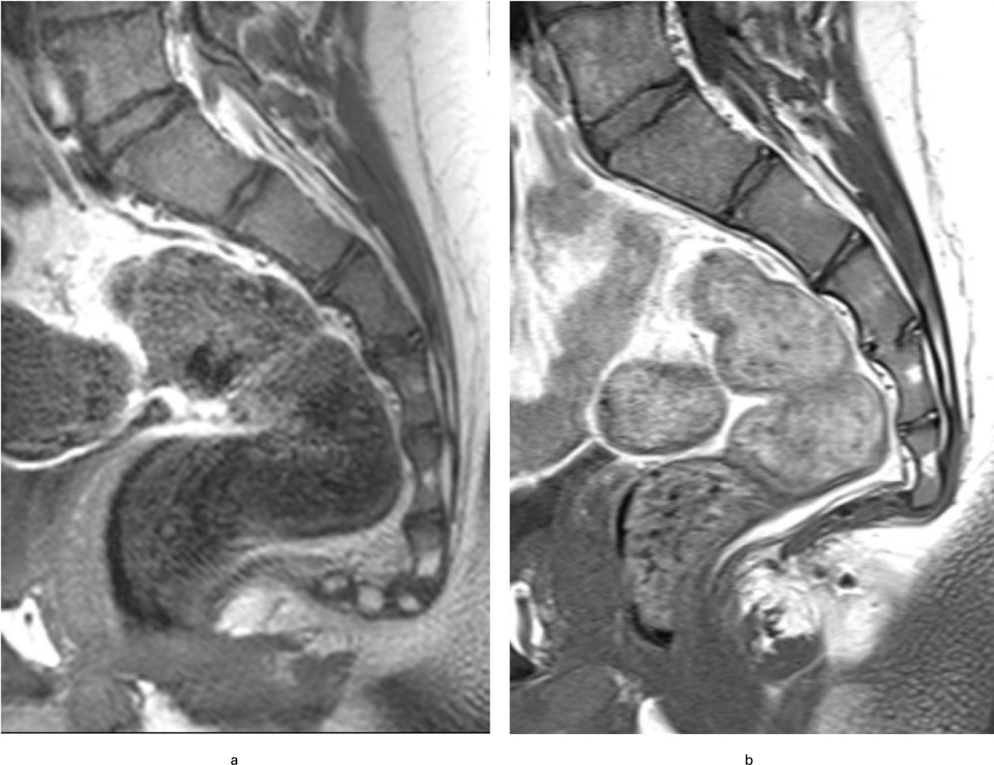 Fig. 1 
          a) 13-year-old boy at referral. b) After surgery.
        