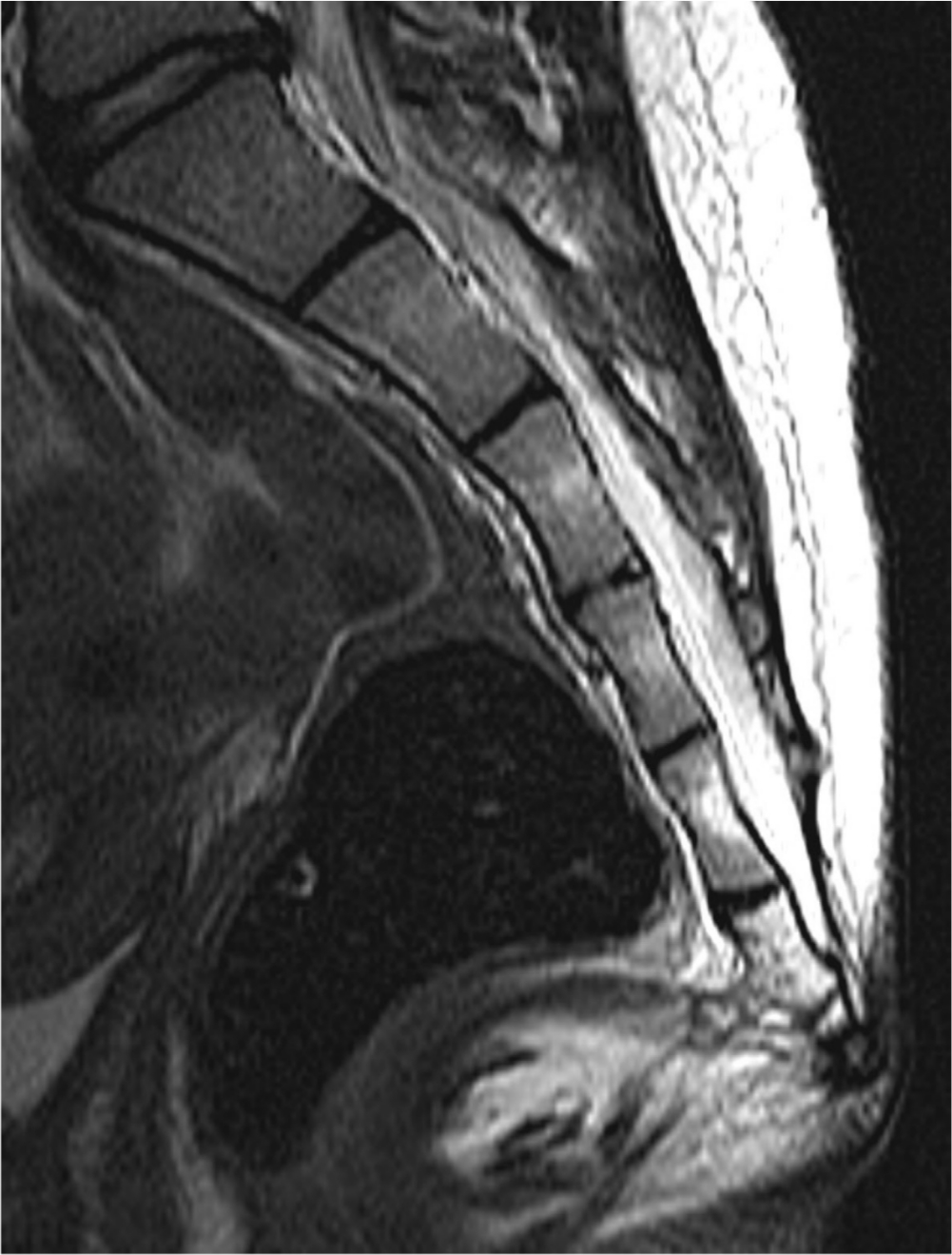 Fig. 2 
          MRI of 15-year-old boy with bony spicula from coccyx.
        
