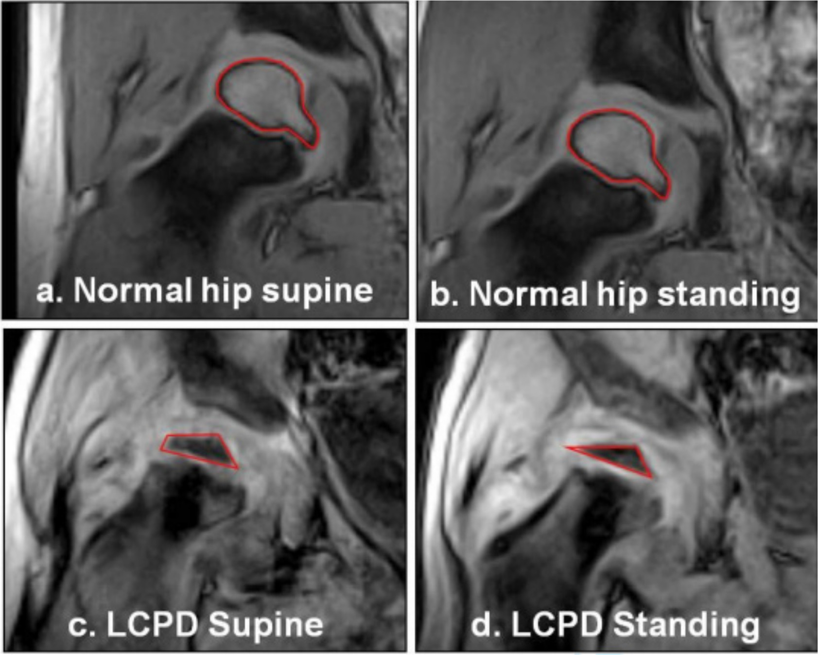 Fig. 3 
          Qualitative representation of femoral head deformity observed in those children with early-stage Legg-Calvé-Perthes disease (LCPD), compared to contralateral normal hips. The normal hips showed no visiblede formation (3a & 3b). The resting deformity of the LCPD hips (3c) was exacerbated on weightbearing (3d). The cartilaginous outline is visible and the ossific nucleus, also deformed, isoutlined in red.
        