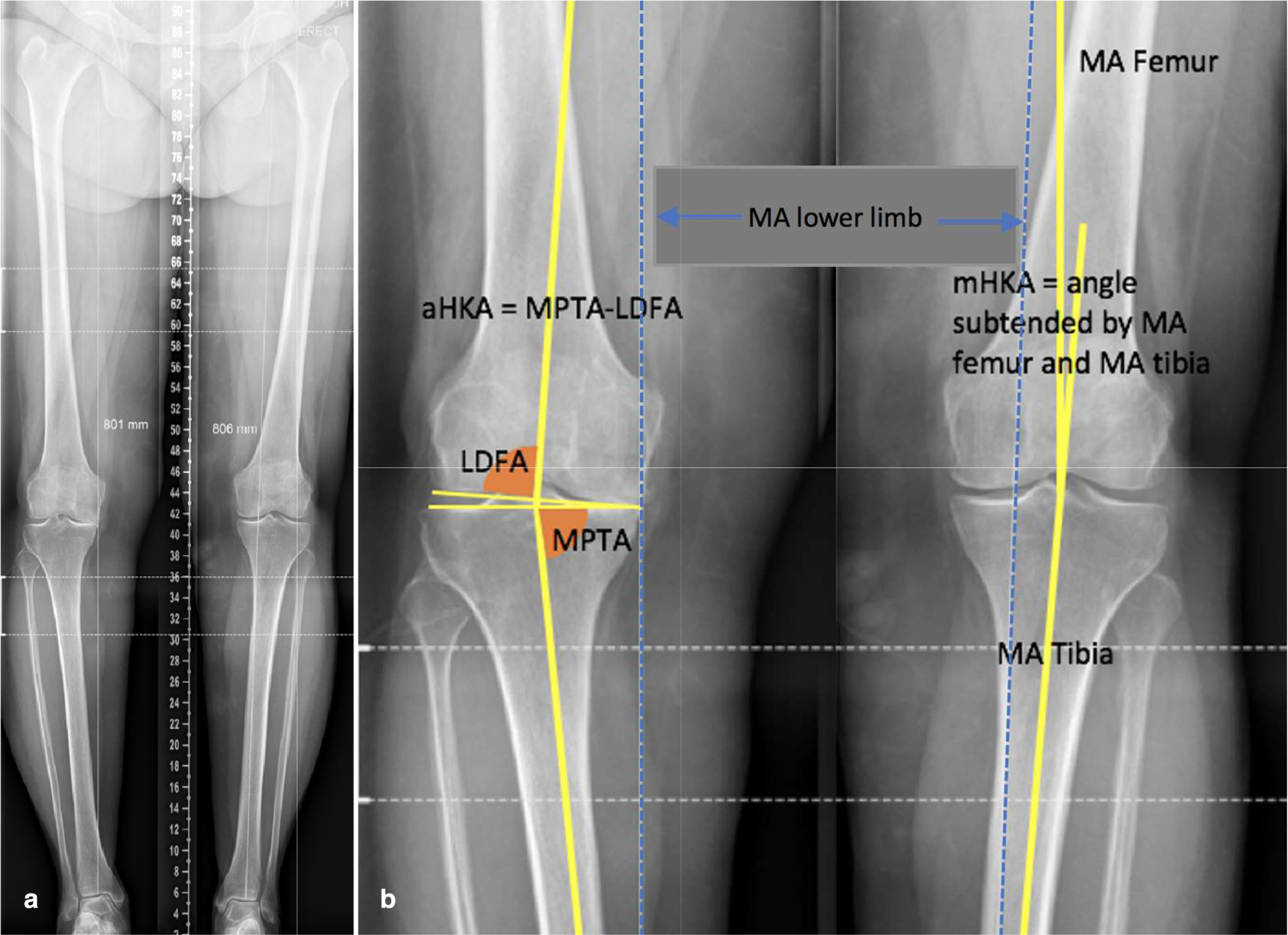 Fig. 1 
            a) Full preoperative long leg standing radiograph. Grade 4 Kellgren-Lawrence tibiofemoral osteoarthritis of right knee. Grade 1 tibiofemoral osteoarthritis left knee, serving as matched control. b) Same long leg radiograph with digital radiological reference lines. Right knee demonstrates calculation of constitutional alignment in the arthritic knee using aHKA algorithm. Left normal knee shows calculation of mHKA. aHKA, arithmetic hip-knee-ankle angle algorithm; LDFA, lateral distal femoral angle; MPTA, medial proximal tibial angle; mHKA, mechanical hip-knee-ankle angle; MA, mechanical axis.
          