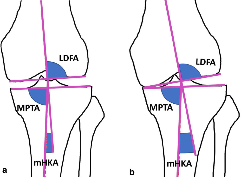 Fig. 2 
            Radiological changes that occur with joint space loss and deformity. a) LDFA, MPTA and mHKA in a knee with preserved joint space and mild constitutional varus alignment. b) The same knee following degenerative loss of medial joint space, showing a change in mHKA and no change to LDFA and MPTA (and therefore, no change to aHKA). mHKA, mechanical hip-knee-ankle angle; LDFA, lateral distal femoral angle; MPTA, medial proximal tibial angle.
          