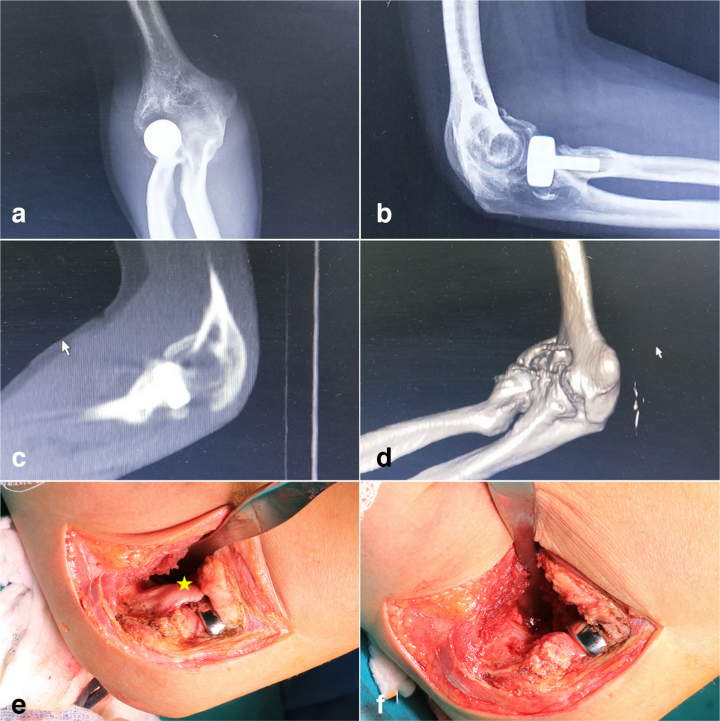 Fig. 2 
            Anterior ectopic bone excision (block removal). a,b) Radiograph, c) sagittal view of calculated tomography (CT), and d) 3D CT reconstruction show heterotopic ossification (HO) in the anterior elbow. e) An irregularly shaped HO (*, yellow) originated from distal humerus can be seen in the anterior elbow from the operative field. f) The ectopic bone is excised under direct visualization intraoperatively.
          