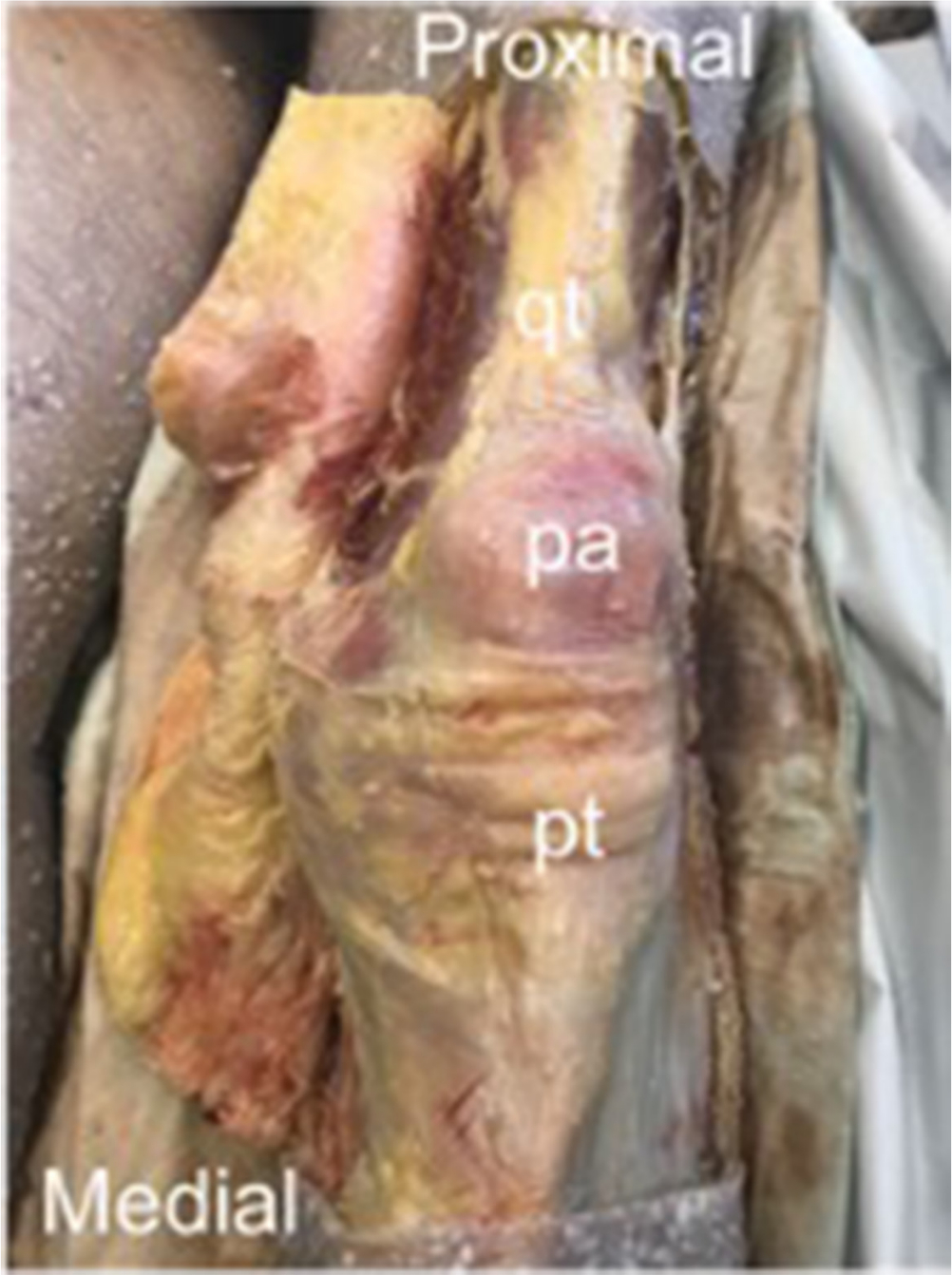 Fig. 1 
            Extended medial flap exposing quadriceps tendon (qt), patella (pa), and patella tendon (pt).
          