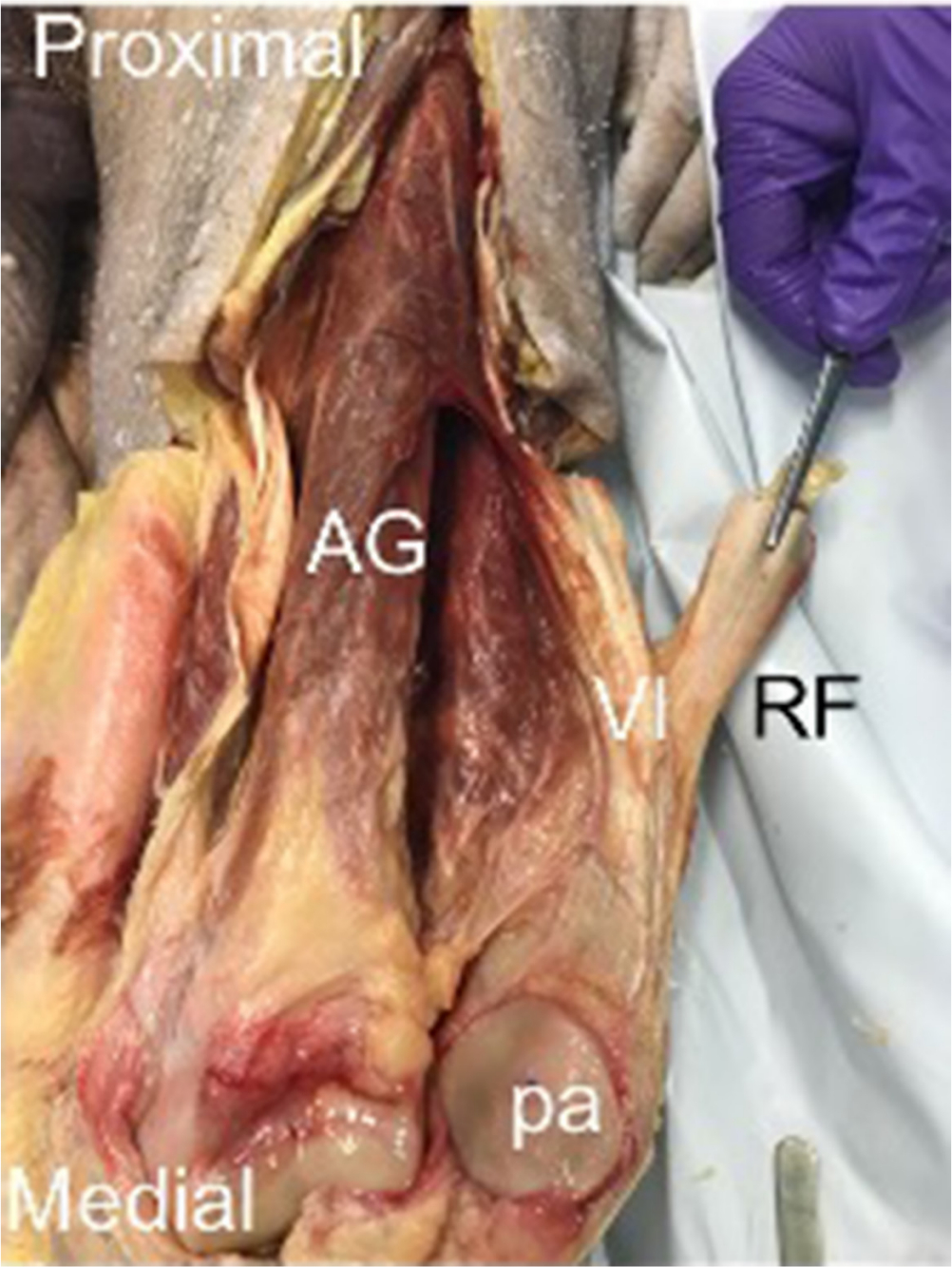 Fig. 2 
            Exposed articularis genu – reflection of rectus femoris (RF) and vastus intermediua (VI) reveals an additional muscle bulk deep to VI, articularis genu (AG). Reflection of the patella (pa) shows insertion of AG into the suprapatellar bursa (sb).
          