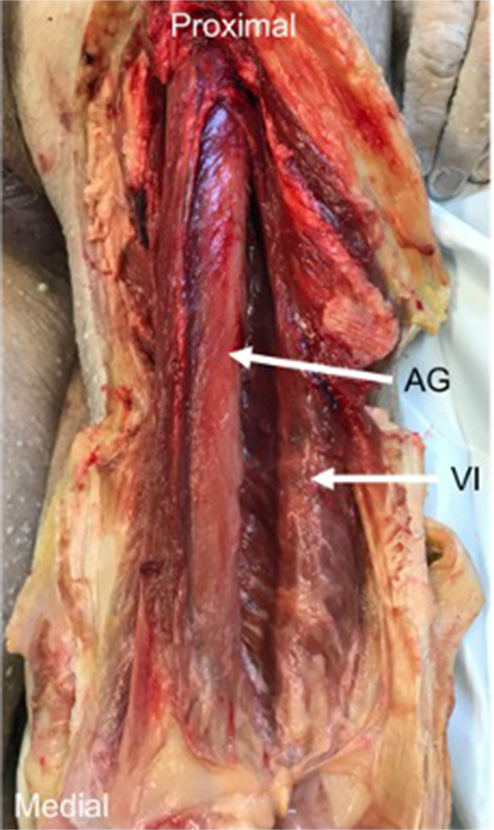 Fig. 3 
            The articularis genu (AG) muscle – dissection of cadavers demonstrated that deep to vastus intermedius (VI), a deeper muscle, and AG could be identified. The two muscles were separated by a fascial plane, and their fibres ran in different directions.
          