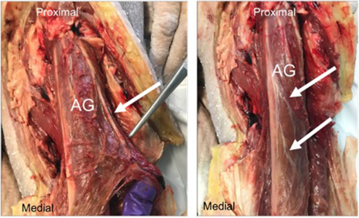 Fig. 5 
            (a) Blood supply to articularis genu (AG) (white arrow); (b) Nerve supply to the AG (white arrows).
          