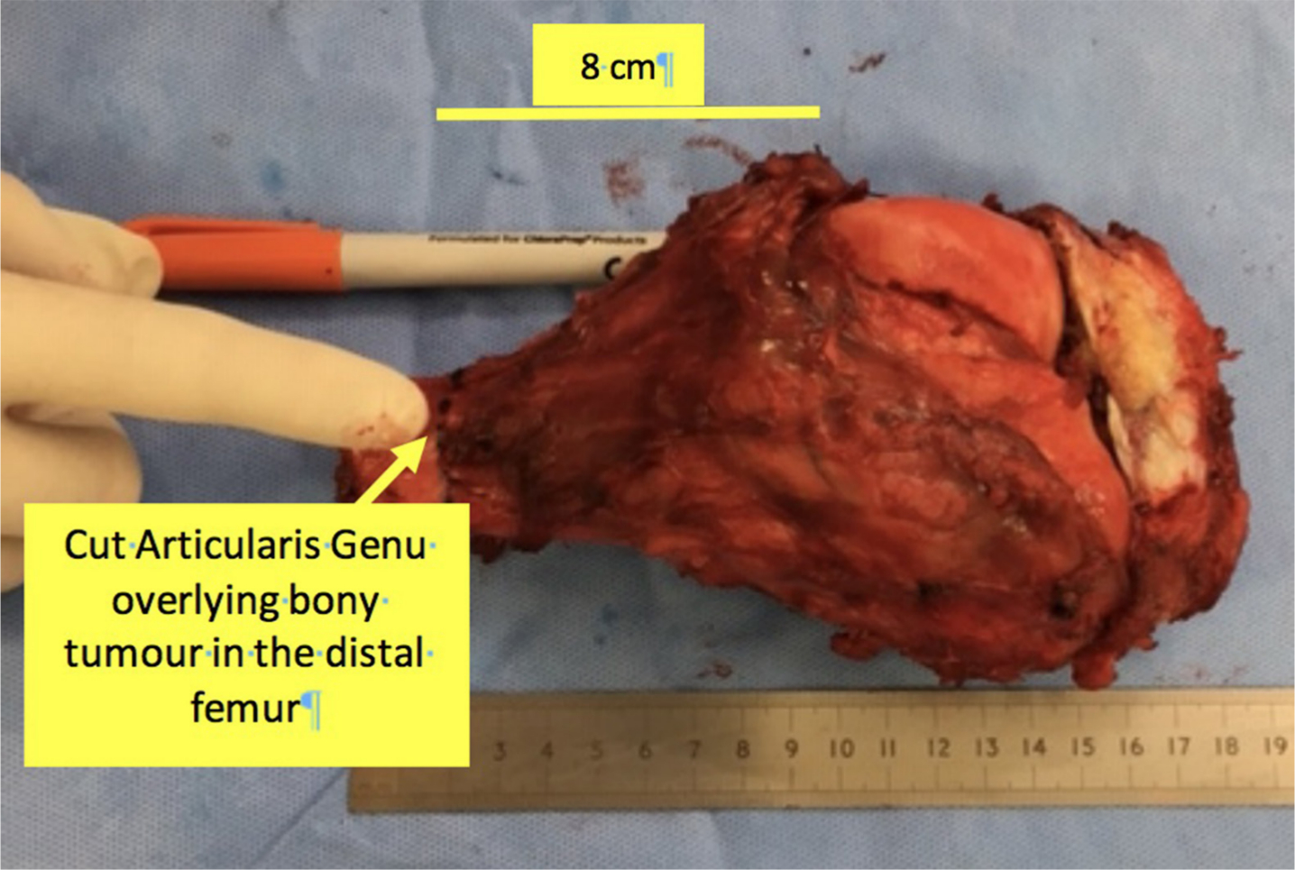 Fig. 6 
            Gross pathological specimen showing articularis genu covering a resected distal femur osteosarcoma.
          