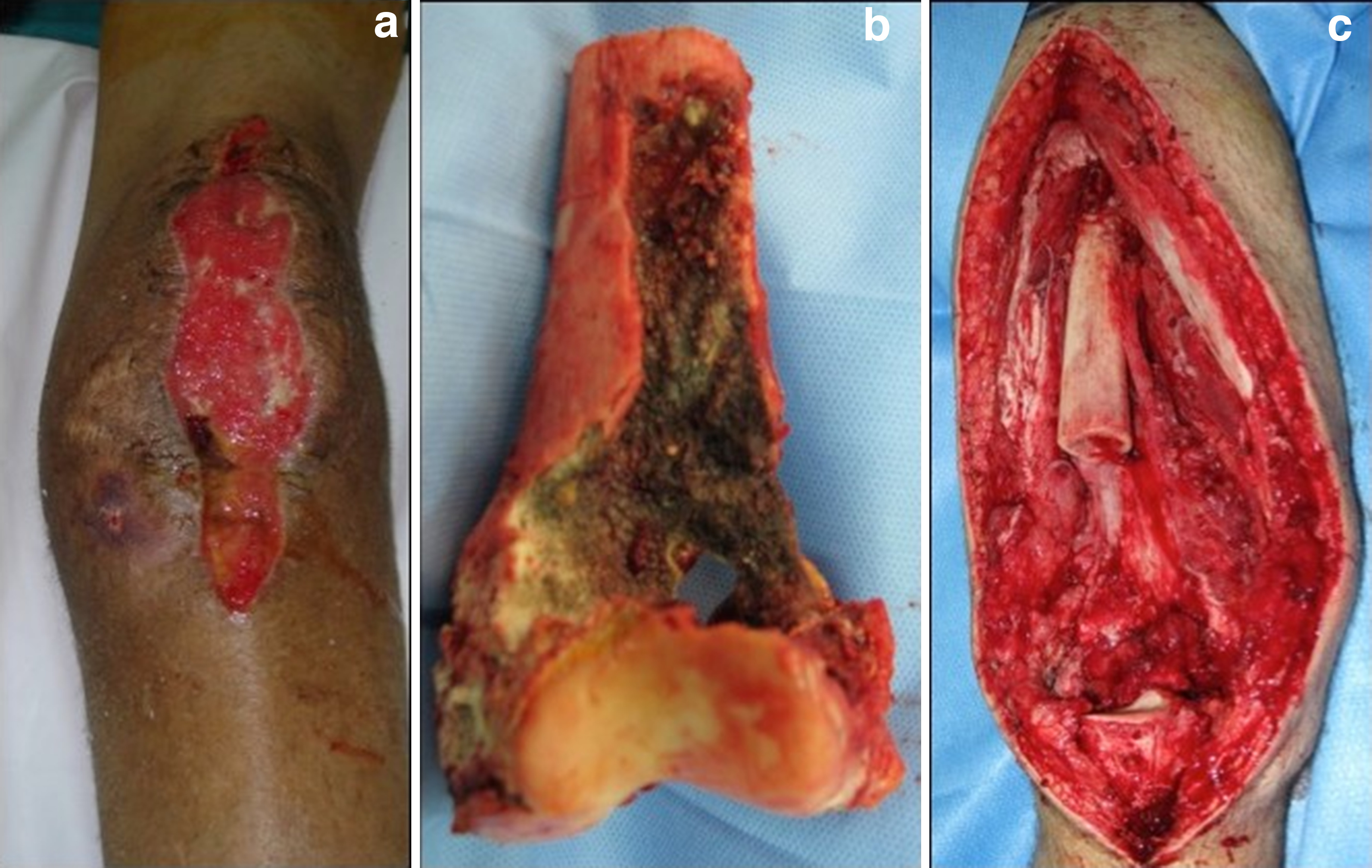 Fig. 1 
          Clinical images of a 26-year-old male patient. a) Surgical wound after multiple open debridements. b) Radical bone resection showing an extensive area of cortical bone compromised by necrotic tissues. c) Intraoperative image after resecting the distal femur and proximal tibia, due to massive fungal contamination.
        