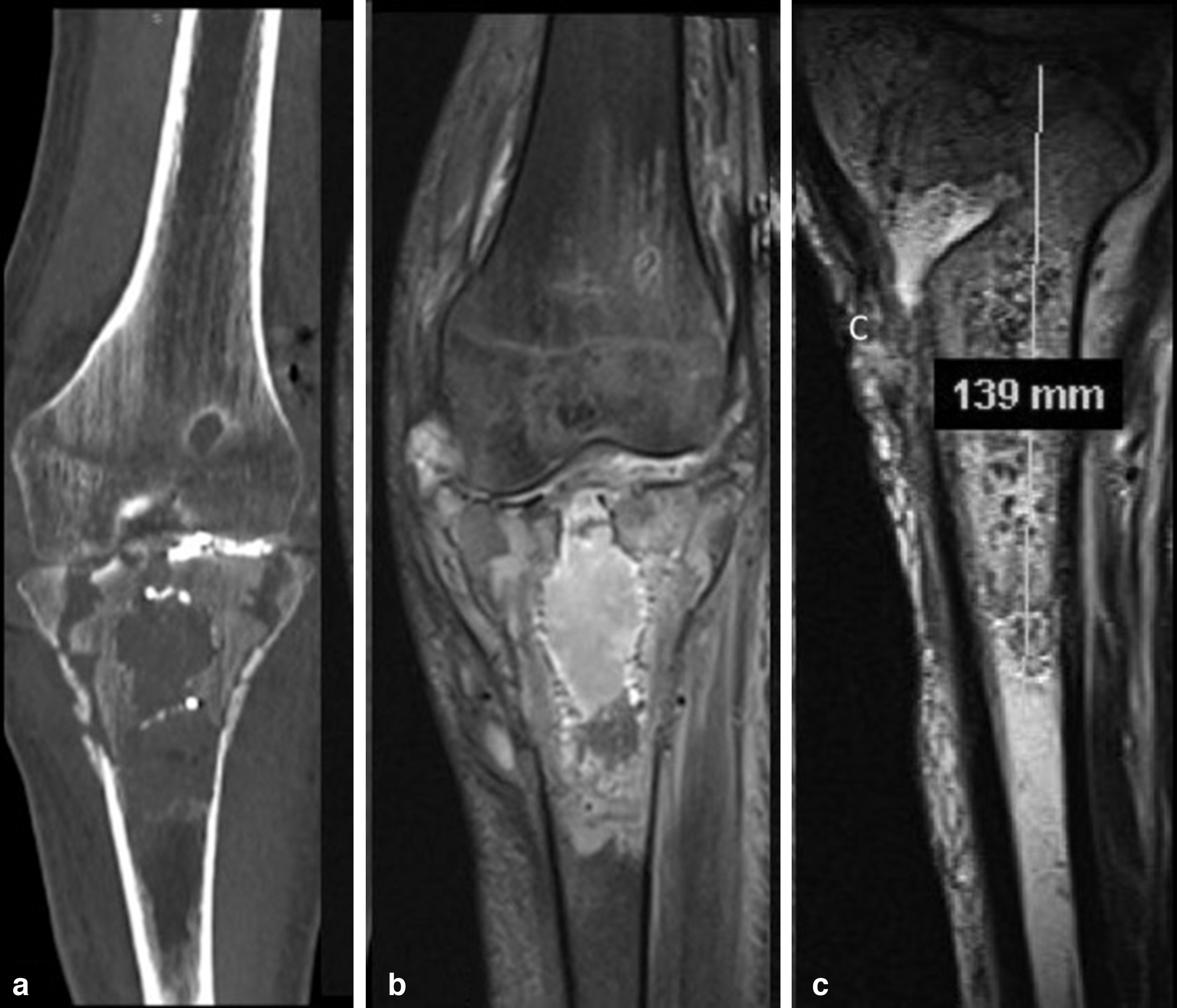 Fig. 2 
          MRI and CT scan images of a 52-year-old male patient show bone and soft tissue compromises at 75-day follow-up. a) A CT scan shows intracavitary and medial cortex lesion of the proximal tibia. b) MRI coronal views show a central cavitary lesion of the proximal tibia surrounded of bone oedema and soft tissue compromise. c) MRI sagittal view, showing the tibial tunnel of the primary anterior cruciate ligament surgery, and a massive bone lesion of 139 mm.
        