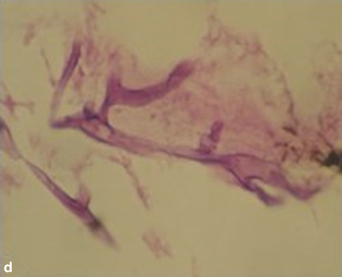 Fig. 3 
          
            Mucoraceous hyphaes are seen in this bone biopsy specimen (hematoxylin and eosin; original magnification × 400).
        