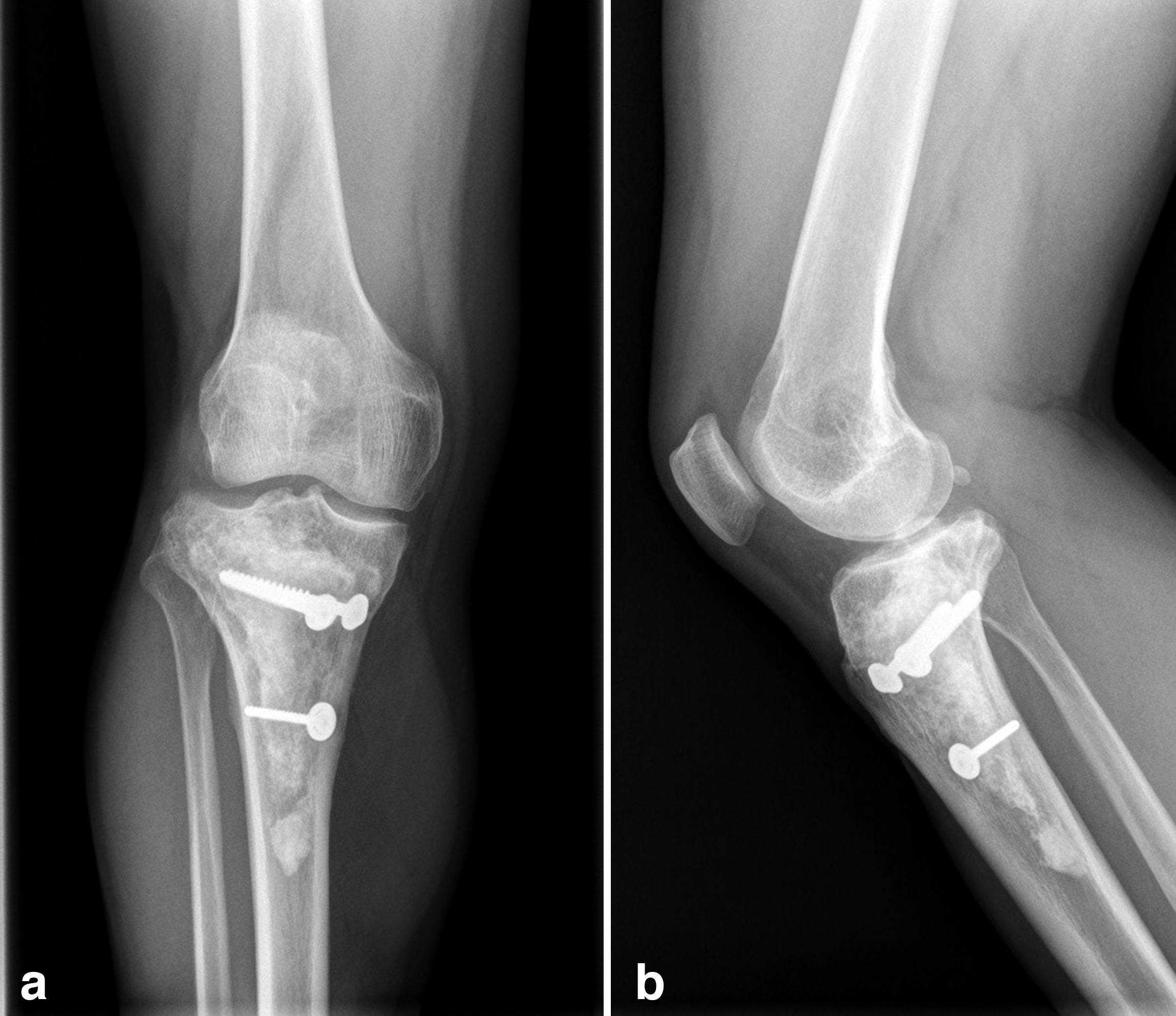 Fig. 4 
          Reconstructive surgery with hemicylindrical intercalary allograft (HIA) in a 29-year-old male patient. a) Anteroposterior and b) lateral view radiographs of a cavitary lesion of the proximal tibia filled with fragmented allograft chips and a HIA fixed with screws after 14 years follow-up.
        