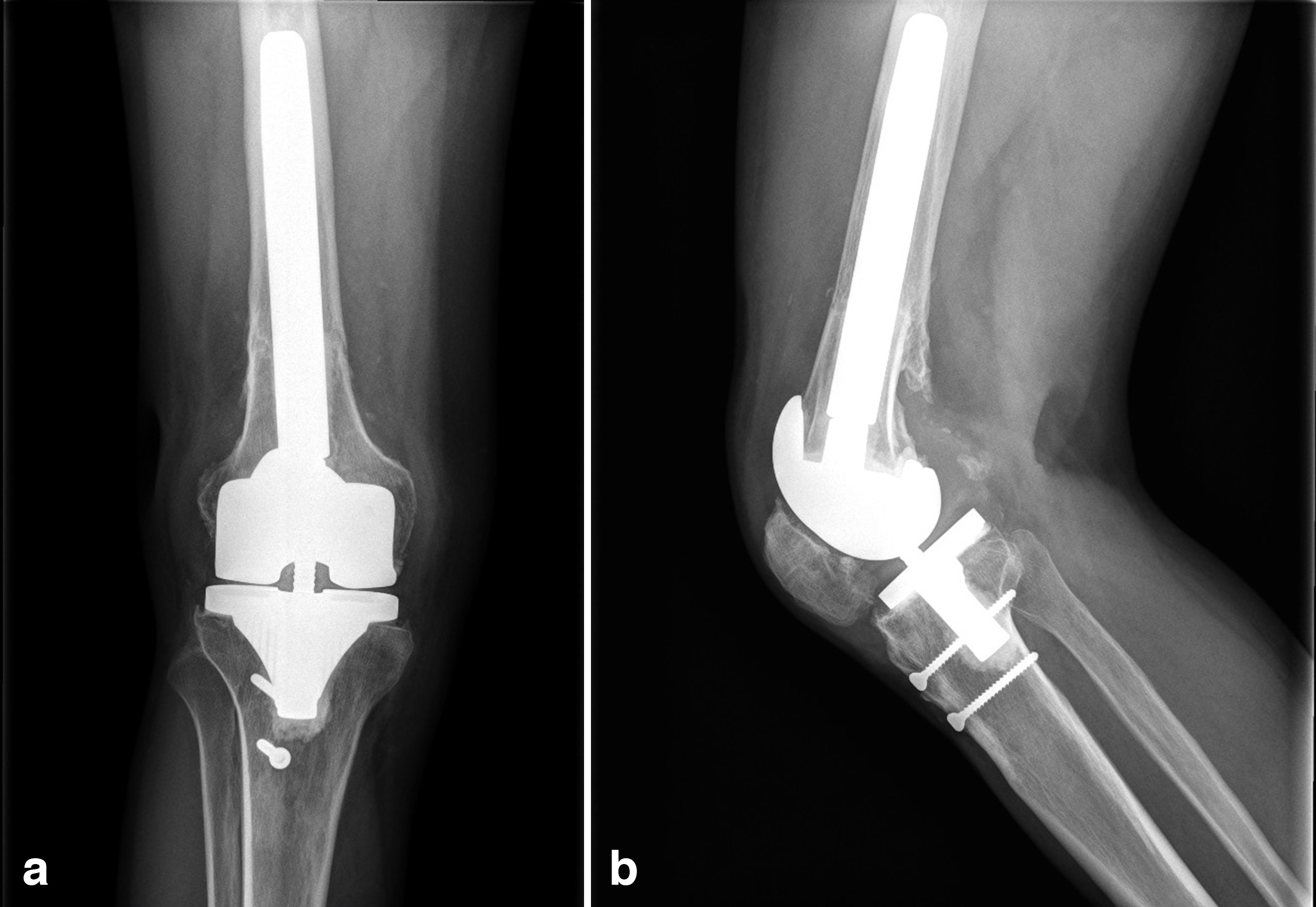 Fig. 5 
          Reconstructive surgery with allograft prostheses composite (APC) in a 25-year-old male patient. Anteroposterior and lateral radiographs show a femoral APC reconstruction at ten years follow-up.
        