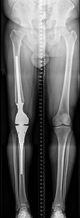 Fig. 6 
          Reconstructive surgery with a tumor-type prostheses (TTP) in a 28-year-old male patient. An anteroposterior radiograph showing a TTP at six years follow-up.
        