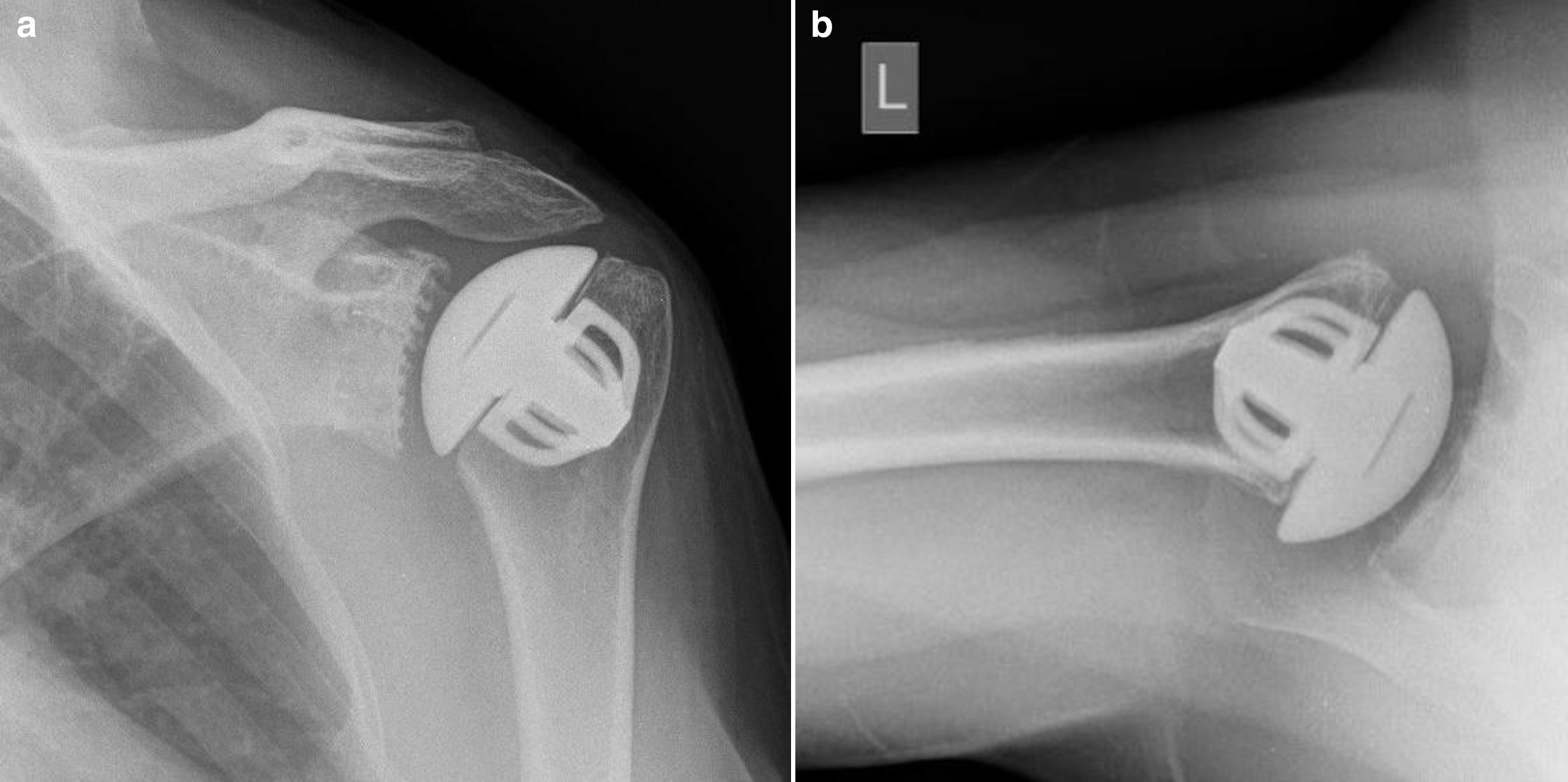 Fig. 2 
            a) Anteroposterior radiograph of the Affinis Short, Short Stem Total Shoulder Prosthesis and b) axillary radiograph of the Affinis Short, Short Stem Total Shoulder Prosthesis in a 72-year-old female patient.
          