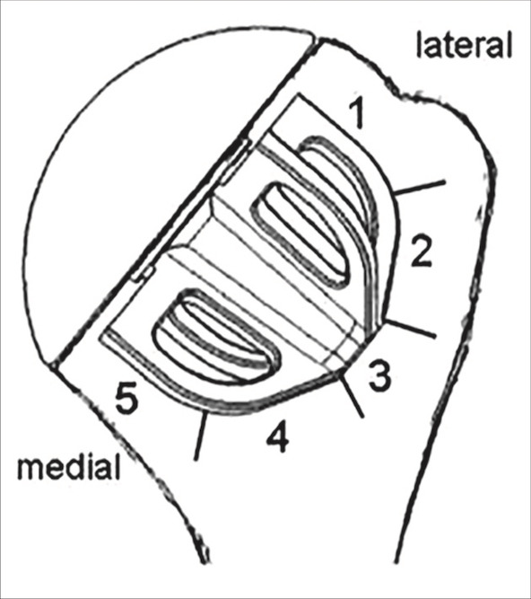Fig. 3 
            Zones of humeral component assessed for radiolucent lines.
          
