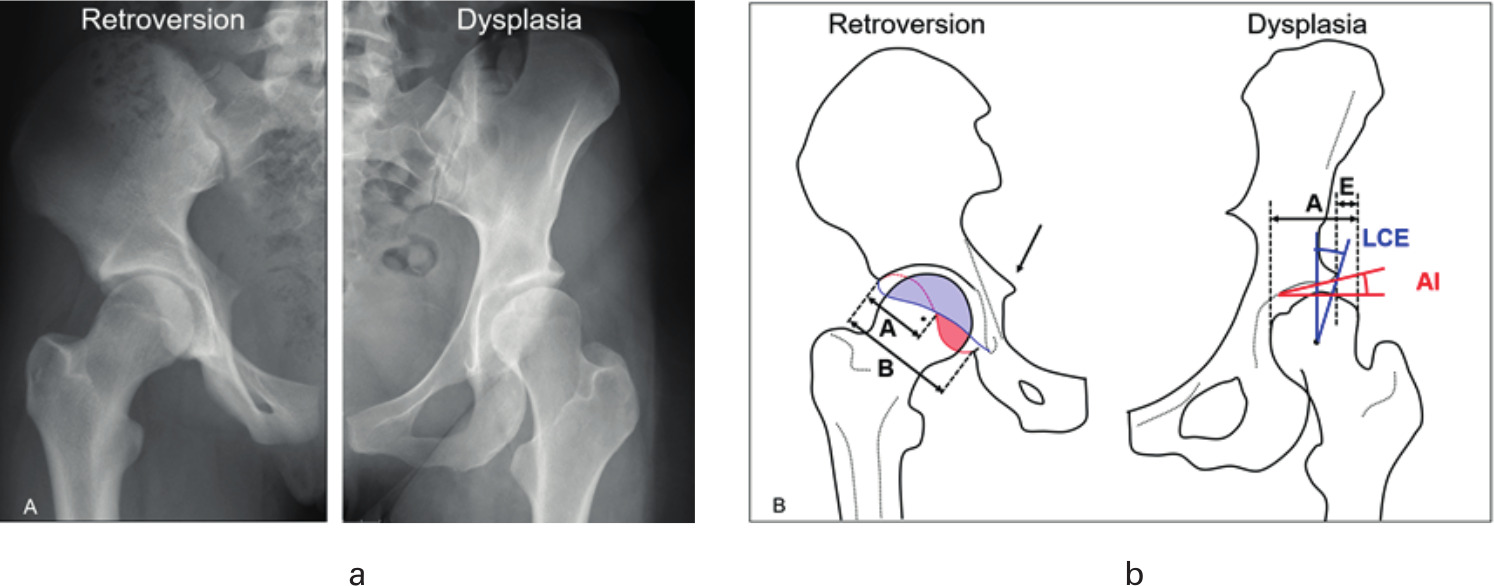 Fig. 1 
          a) Radiological and b) schematic views of young patients with hip pain due to acetabular retroversion (left) and hip dysplasia (right). b) Three radiological signs of acetabular retroversion are shown (positive ischial spine sign, posterior wall sign and crossover sign with retroversion index of >50%) . AI, acetabular index; LCE, lateral-centre edge.
        