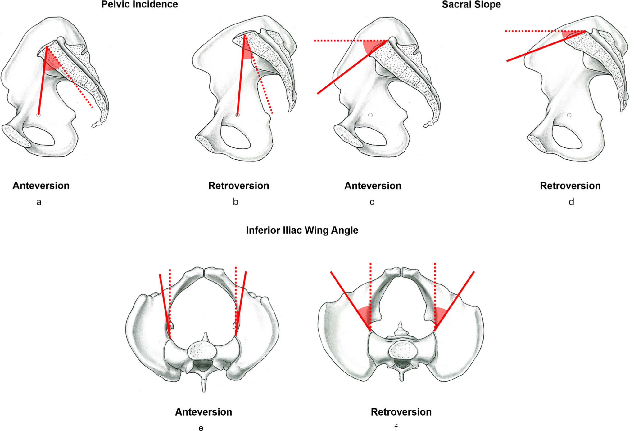 Fig. 3 
            a) and b) Sagittal profiles of a pelvic bone of a patient with a) and c) high acetabular anteversion, and b) and d) a patient with acetabular retroversion (AR). e) Hips with AR have more external rotation of the iliac wing compared to f) hip dysplasia.
          