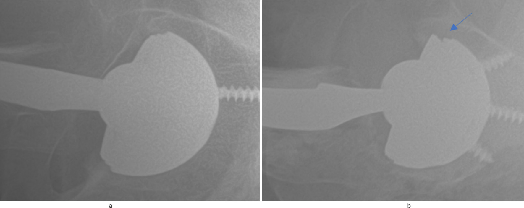 Fig. 1 
          A well-malseated versus a malseated Stryker Trident implant. a) A non-malseated Stryker Trident implant demonstrating no gaps between the liner and the rim of the acetabular shell. A well-malseated versus a malseated Stryker Trident implant. b) A malseated Stryker Trident implant with a clear gap between the metal back of the liner and the rim of the acetabular shell.
        