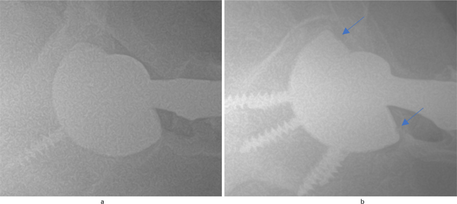 Fig. 2 
          A well-malseated Zimmer Biomet G7 implant versus a malseated Zimmer Biomet G7 implant. a) A non-malseated Biomet G7 implant. A well-malseated Zimmer Biomet G7 implant versus a malseated Zimmer Biomet G7 implants. b) Malseated Zimmer Biomet G7 implants with gaps seen along the implant surface.
        