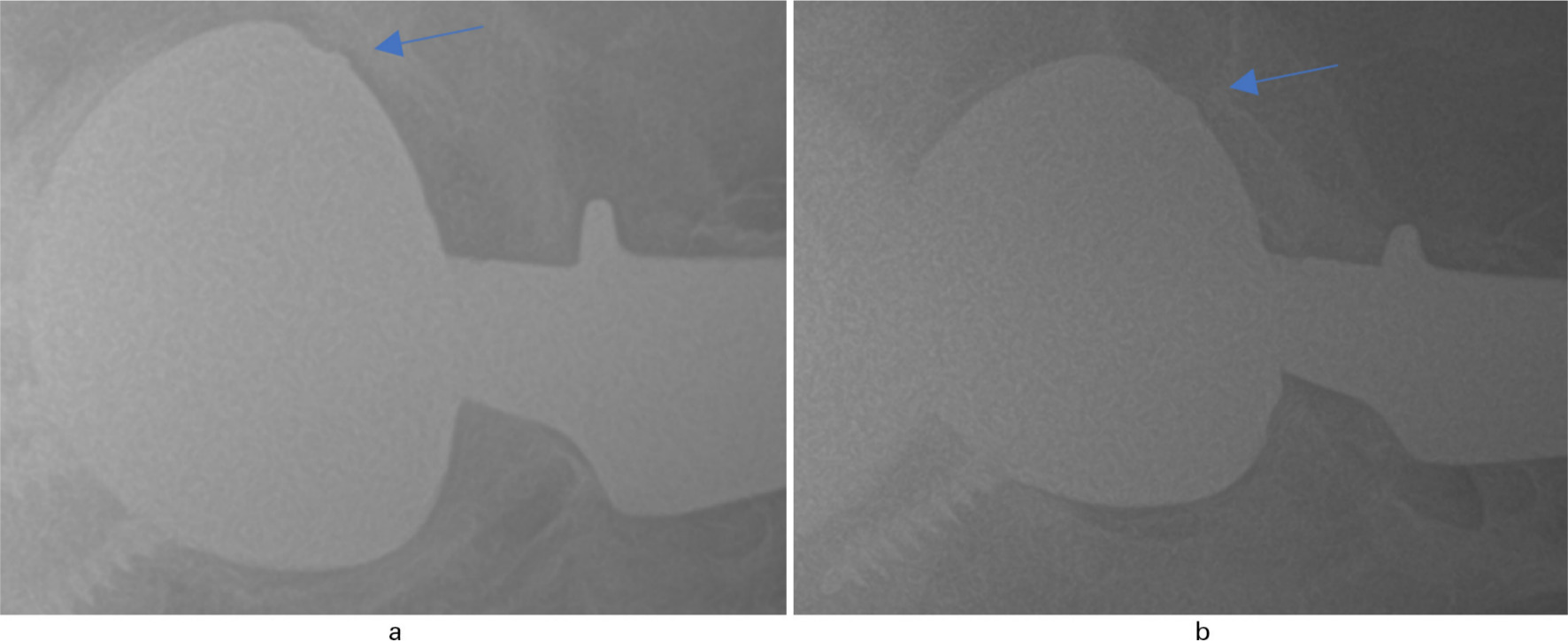 Fig. 3 
          Two radiographs taken on the same day of a Stryker Trident implant demonstrating how the same implant can look different on two separate radiographs taken on the same day; a) A Stryker Trident II implant demonstrating possible concern for malseating. b) The same Stryker Trident II implant from a radiograph taken on the same day demonstrating lower concern for malseating.
        