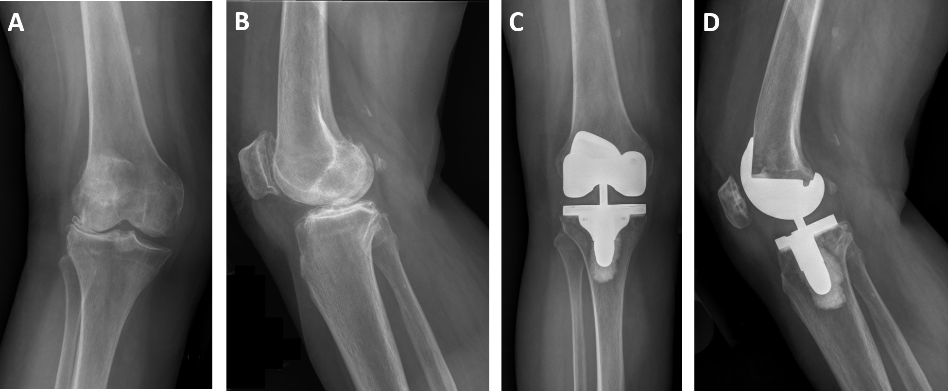 Fig. 1 
          a) Preoperative anteroposterior; and b) lateral radiographs of a patient with a valgus deformity. c) Posteroperative anteroposterior; and d) lateral radiographs depicting correction of the valgus deformity with the posterior-stabilized femoral component and varus-valgus insert.
        