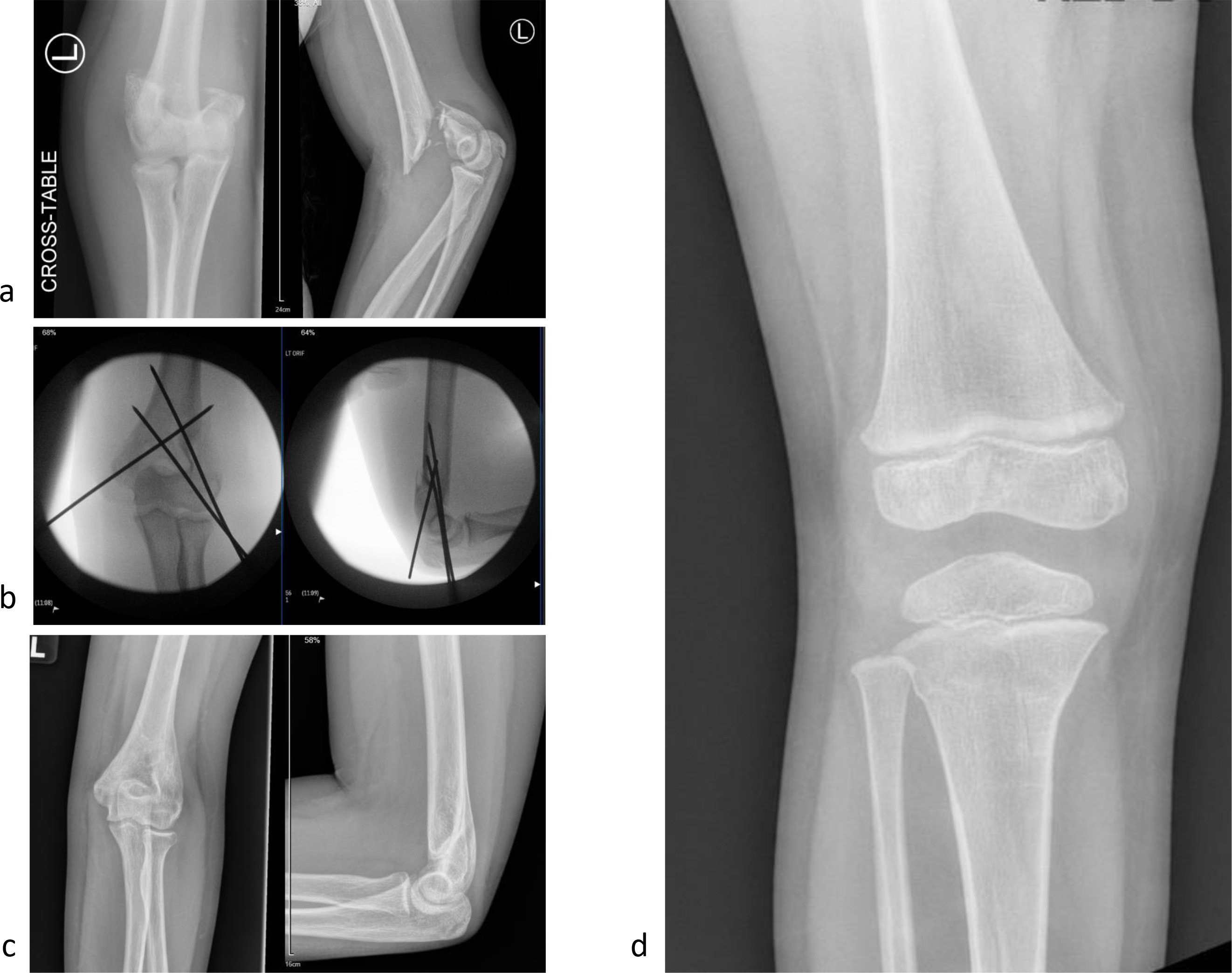 Fig. 1 
          Examples of typical trampolining presentations observed during the lockdown period. These are high energy injuries in these age groups. a) A 13-year-old female patient with an atypical supracondylar fracture b) This highly unstable fracture required emergent fixation with three Kirschner wires. c) Satisfactory radiological union at four-month follow-up. d) A four-year-old male patient with proximal tibial buckle fracture.
        